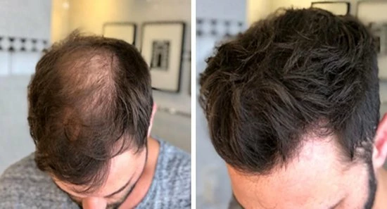 Beste deal π IMPERIO Premium Haarvezels Donkerbruin - Kaalheid Mannen - Alopecia Vrouwen - 100% Onzichtbaar π 18 Beste deal π IMPERIO Premium Haarvezels Donkerbruin - Kaalheid Mannen - Alopecia Vrouwen - 100% Onzichtbaar π - Afbeelding 16