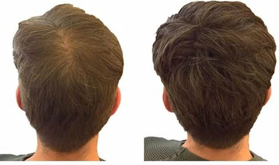 Beste deal π IMPERIO Premium Haarvezels Donkerbruin - Kaalheid Mannen - Alopecia Vrouwen - 100% Onzichtbaar π 17 Beste deal π IMPERIO Premium Haarvezels Donkerbruin - Kaalheid Mannen - Alopecia Vrouwen - 100% Onzichtbaar π - Afbeelding 15