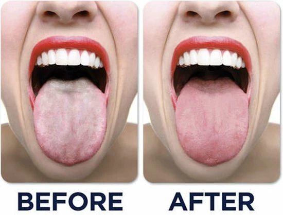 Beste Verkoop π JuliBrite Tong Gel (50 ML) Tongreinigende Gel - Verfrist De Adem - Schone Tong 𧨠6 Beste Verkoop π JuliBrite Tong Gel (50 ML) Tongreinigende Gel - Verfrist De Adem - Schone Tong 𧨠- Afbeelding 4