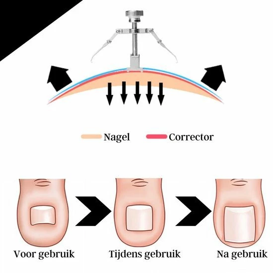 Gloednieuw 🤩 LOUZIR 7-Delige Pedicure Set - Nagelverzorging - Nagelset - Ingegroeide Teennagel - Nagelknipper - Nail Clippers - Ingrown Toenail 💯 16 Gloednieuw 🤩 LOUZIR 7-Delige Pedicure Set - Nagelverzorging - Nagelset - Ingegroeide Teennagel - Nagelknipper - Nail Clippers - Ingrown Toenail 💯 - Afbeelding 14