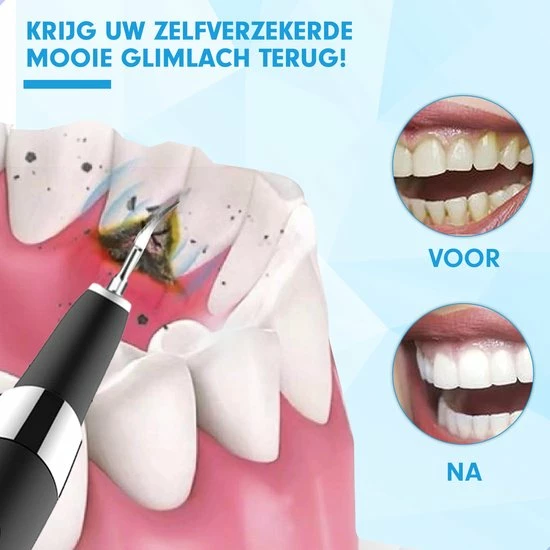 Goedkoop 💯 DEN-T® PRO U500 - Elektrische Sonische Tandsteen Verwijderaar - Zwart 🥰 6 Goedkoop 💯 DEN-T® PRO U500 - Elektrische Sonische Tandsteen Verwijderaar - Zwart 🥰 - Afbeelding 4
