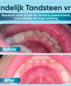 Beste Verkoop π ProTrue Whitee Elektrische Tandsteen Verwijderaar - Tanden Polijsten - Tandarts Tandsteenverwijderaars - Elektrisch Tandplak Verwijderen β 23 Beste Verkoop π ProTrue Whitee Elektrische Tandsteen Verwijderaar - Tanden Polijsten - Tandarts Tandsteenverwijderaars - Elektrisch Tandplak Verwijderen β -L'OrΓ©al Shop 550x550 577