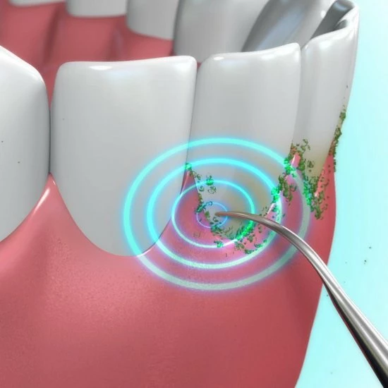 Beste recensies van ✨ Toppers Van TV - Sonic Tandsteenverwijderaar - Tandplakverwijderaar ⭐ 9 Beste recensies van ✨ Toppers Van TV - Sonic Tandsteenverwijderaar - Tandplakverwijderaar ⭐ - Afbeelding 7