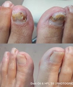 Top 10 π HFL Laboratories Solutionspray De Nummer 1 Tegen Schimmelnagels! - HFL - Laboratories - Solution Spray - 50ml + Dadi'Oil Nagelriem Olie - 3.75ml - Kalknagel Spray - Schimmelnagel Spray - Nagelriem Olie - Nagelverzorging π 9 Top 10 π HFL Laboratories Solutionspray De Nummer 1 Tegen Schimmelnagels! - HFL - Laboratories - Solution Spray - 50ml + Dadi'Oil Nagelriem Olie - 3.75ml - Kalknagel Spray - Schimmelnagel Spray - Nagelriem Olie - Nagelverzorging π -L'OrΓ©al Shop 550x619 3