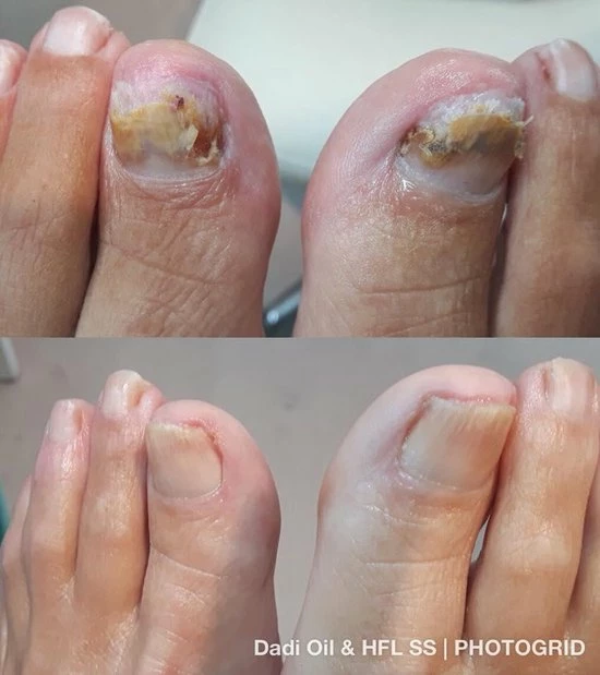 Top 10 π HFL Laboratories Solutionspray De Nummer 1 Tegen Schimmelnagels! - HFL - Laboratories - Solution Spray - 50ml + Dadi'Oil Nagelriem Olie - 3.75ml - Kalknagel Spray - Schimmelnagel Spray - Nagelriem Olie - Nagelverzorging π 6 Top 10 π HFL Laboratories Solutionspray De Nummer 1 Tegen Schimmelnagels! - HFL - Laboratories - Solution Spray - 50ml + Dadi'Oil Nagelriem Olie - 3.75ml - Kalknagel Spray - Schimmelnagel Spray - Nagelriem Olie - Nagelverzorging π - Afbeelding 4